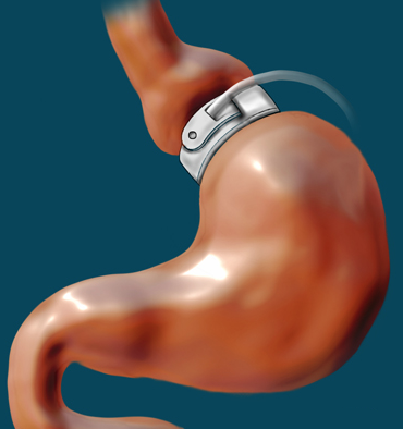 anneau gastrique