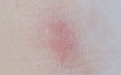 marqueurs biologiques inflammation