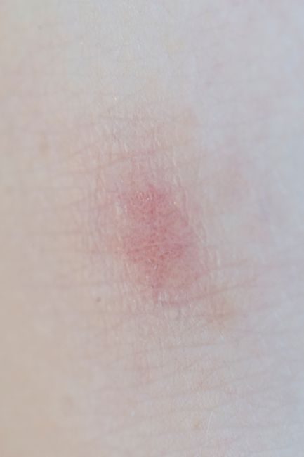 Marqueurs biologiques inflammation : les indicateurs clés à surveiller – consultation nutritionniste