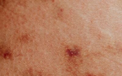 inflammation chronique de bas grade