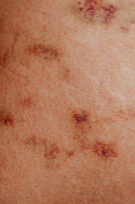 Qu'est-ce que l'inflammation chronique de bas grade ? – consultation nutritionniste